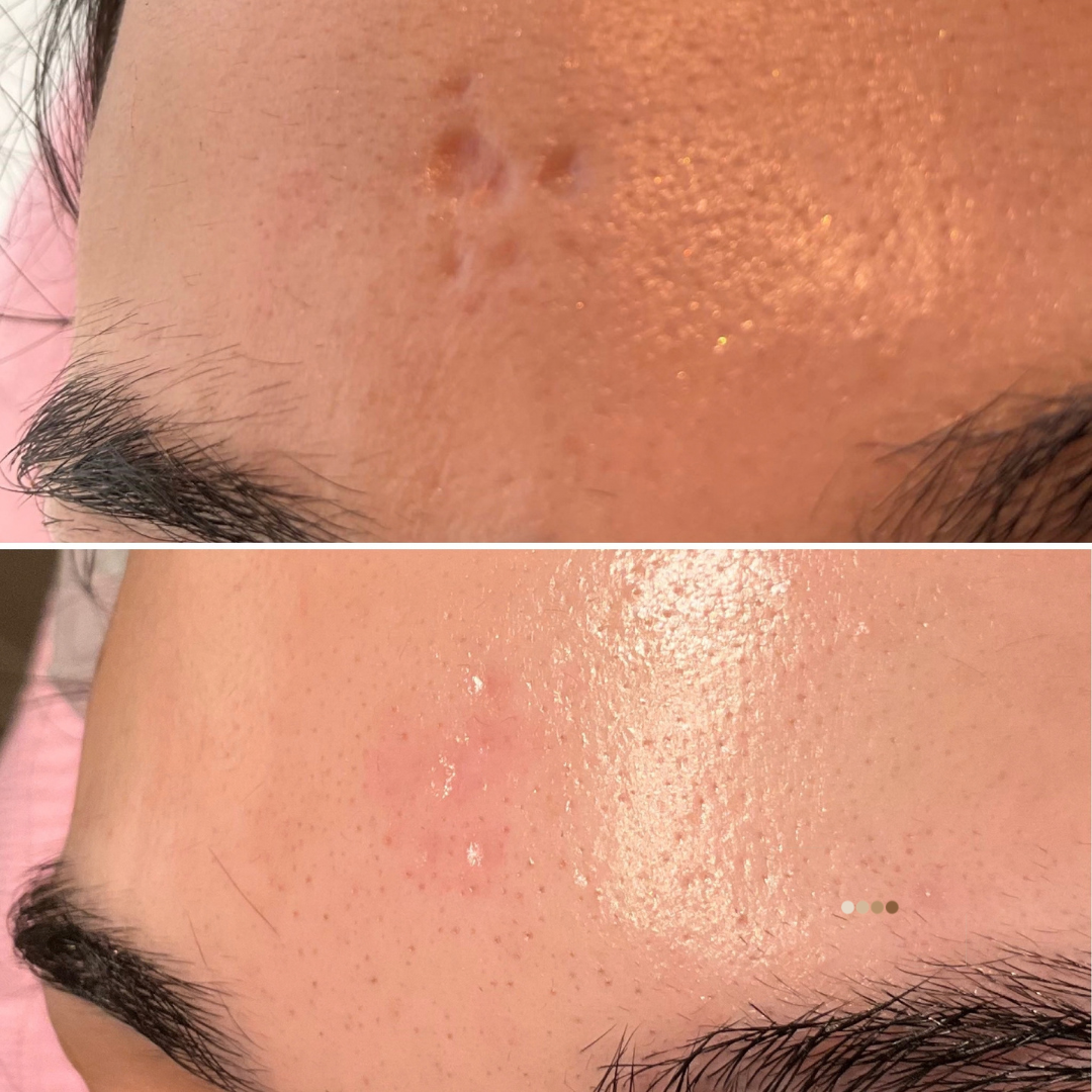 Clinical before and after photographs of forehead boil scar treatment showing skin texture improvement at four-month review